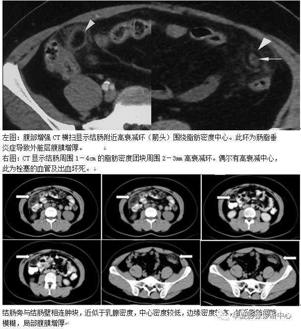 收藏這38個腹部影像征像，每天都用得著