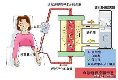得了尿毒癥，透析和換腎哪個(gè)存活期更長(zhǎng)？收藏轉(zhuǎn)發(fā)！